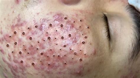 Treatment Of Big Blackheads And Hidden Acne In The Face Youtube