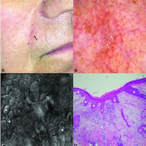 Pigmented Basal Cell Carcinoma On The Left Nasal Bridge Mimicking