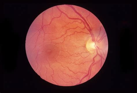 Normal Retina Retina Image Bank