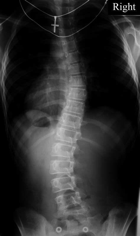 A Case 3 Postero Anterior Scoliosis Radiograph Of An 8 Year Old