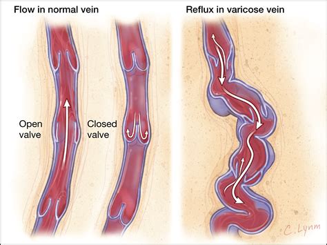 Management Of Varicose Veins And Venous Insufficiency Dermatology Jama Jama Network
