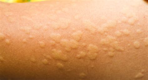 Hives Urticaria In Babies And Toddlers Babycenter India