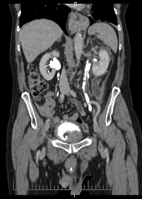 Coronal Section Ct Image Demonstrating Fluid Collection Open I