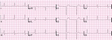 Dr Smiths Ecg Blog Reciprocal St Depression In Ii Iii Avf What Is