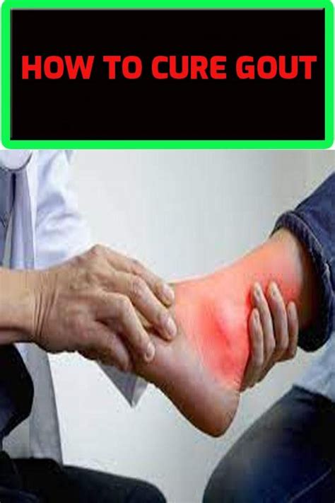 How To Treat Gout Artofit