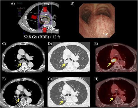 Frontiers Carbon Ion Radiotherapy For Isolated Lymph Node Metastasis