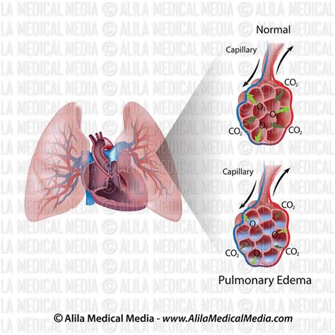 Alila Medical Media Edema Pulmonar Ilustraci N M Dica