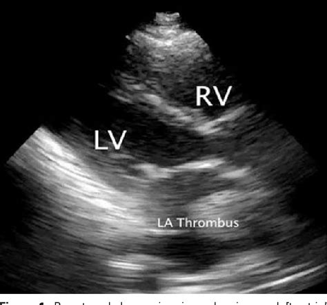 Figure 1 From Emergency Department Diagnosis Of Mitral Stenosis And