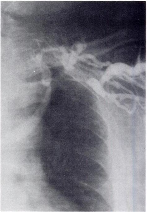 Axillosubclavian Vein Thrombosis Produced By Retrosternal Thyroid Chest