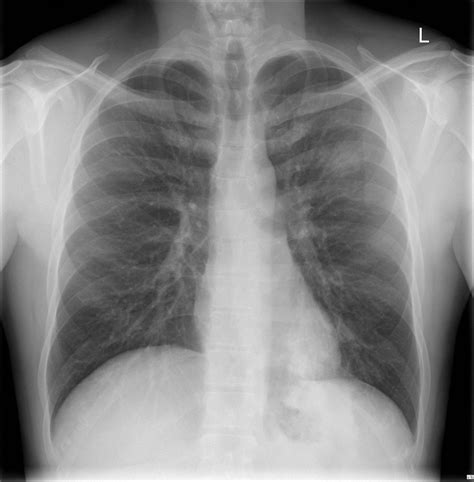 Pneumonia Case 003 Litfl Ultrasound Library