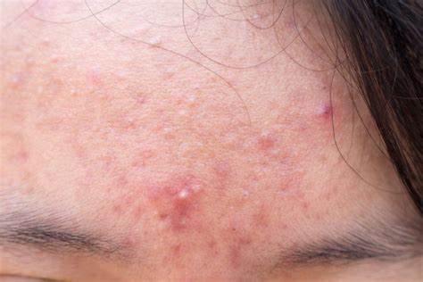 Los Tipos de granos que nos salen en la cara y la forma de tratar cada uno según los dermatólogos
