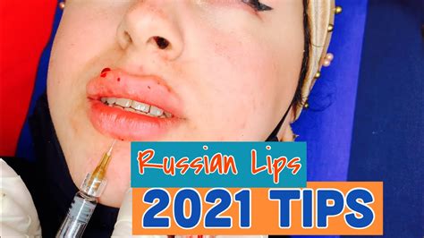 Russian Lips My Beautiful Client Got Big And Beautiful Lips Watch Till End Youtube