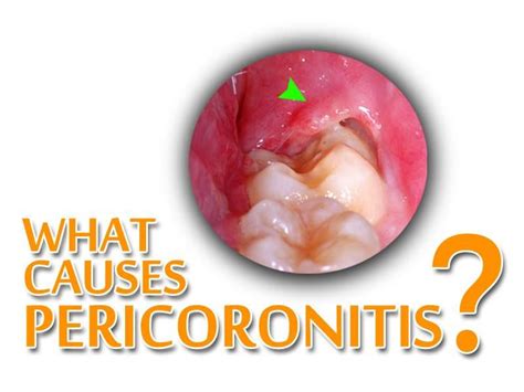 What Causes Pericoronitis Pericoronitis Will Develop Once Wisdom Teeth