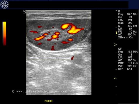 Normal And Enlarged Lymph Nodes Ultrasound Cases Info