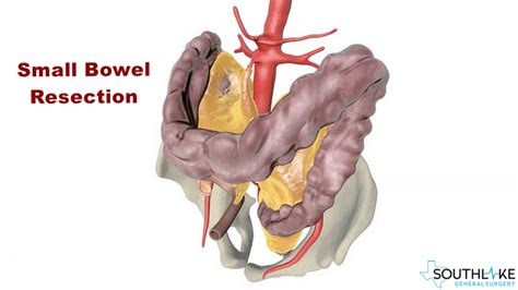 Small Bowel Problem Diagnosis Symptoms Treatmnent And Risk Factors