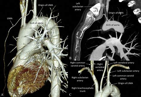 Anomalous Left Internal Mammary Artery A Cardiologists Conundrum