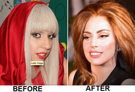 Lady Gaga Plastic Surgery Nose Job Before And After Lady Gaga Plastic Surgery Lady Gaga Nose