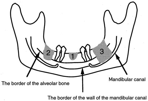 Diagram Showing The Grade Of Bone Invasion Into The Mandible 1