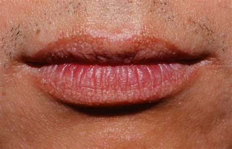Tips To Prevent And Treat Fordyce Spots On Lips