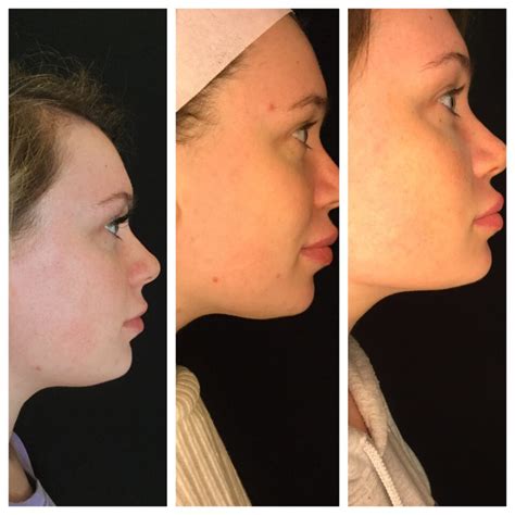 Beforeafter Botox Filler Kybella Laser Skin Care Augusta Ga