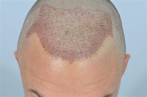 How Should A Person Look Immediately After A Hair Transplant Hair
