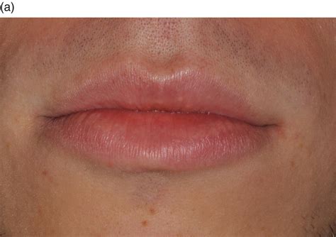 White Spots On Labial Mucosa