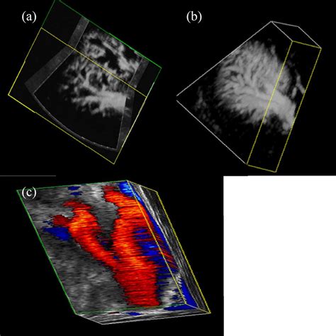 Three Dimensional Ultrasound Images Obtained Using A Mechanical