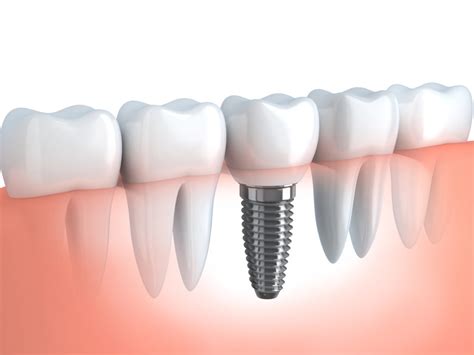 Dental Implants Single Tooth Replacement