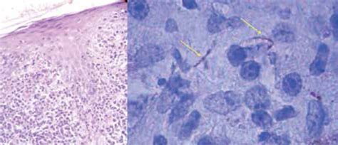 Scielo Brasil Papulonodular Secondary Syphilis A Rare Clinic