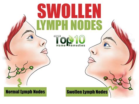 Swollen Lymph Nodes Chin