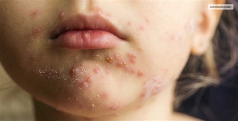 How To Remove Chicken Pox Scars Treatment And Skincare Tips