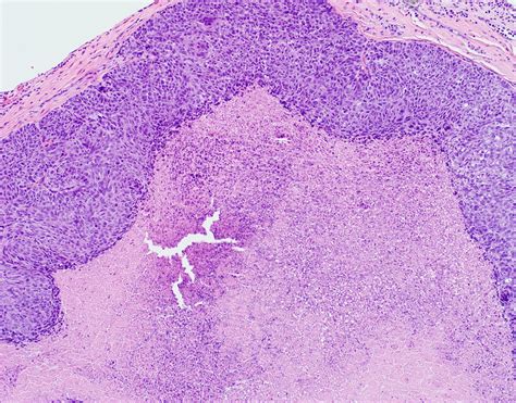 Pathology Outlines Sebaceous Carcinoma