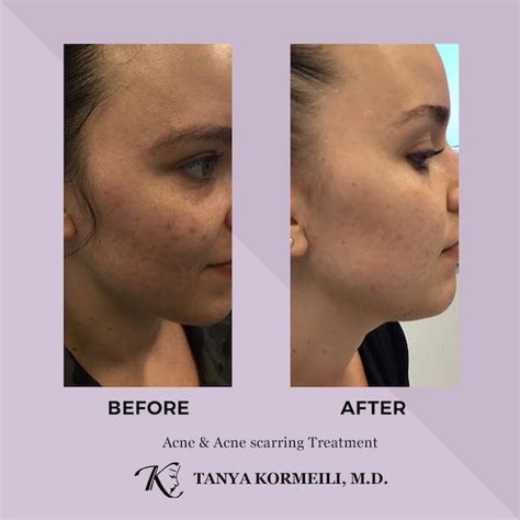Best Skin Complexion Treatment Los Angeles And Santa Monica Dr Tanya Kormeili Dermatology