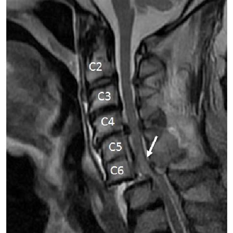 T2 Weighted Cervical Mri On Sagittal View Revealed A Vertically