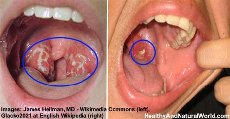 White Spots On Tonsils 6 Common Causes And Effective