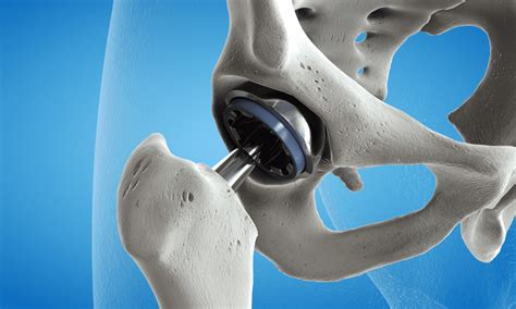 What Is A Joint Replacement Elite Sports Medicine Orthopedics