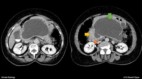Ultimate Radiology Pancreatic Pseudocyst With Duct Communication Ct