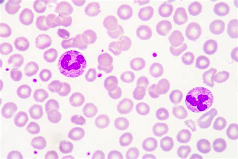 Abnormal Amount Of White Blood Cells Healthfully