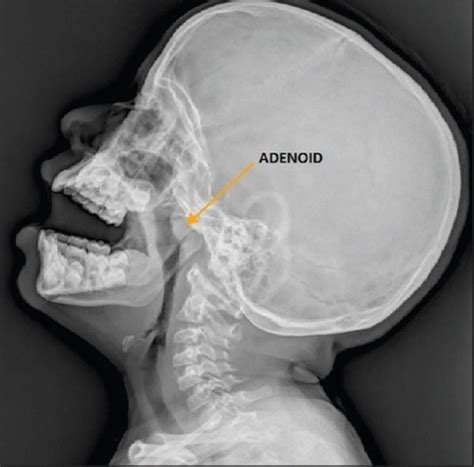 X Ray Nasopharynx Lateral View Showing Adenoid Open I