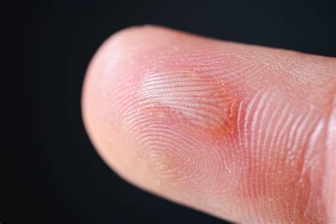 Callo En El Dedo Medio De La Mano Del Hombre Imagen De Archivo Imagen