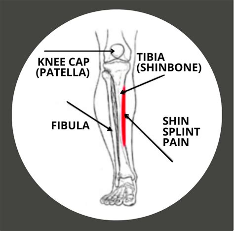 Shin Splints Guide Easthill Physiotherapy And Acupuncture