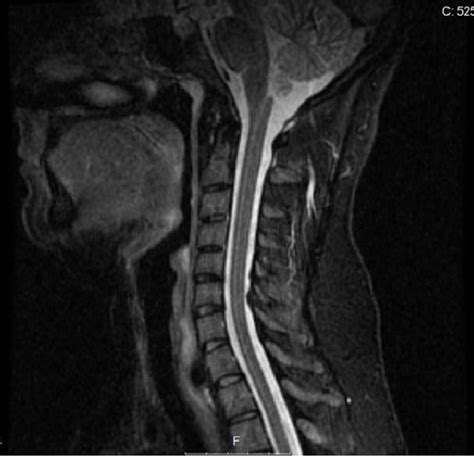 Mri Cervical Spine Without Contrast Showing Mild Multisegmental