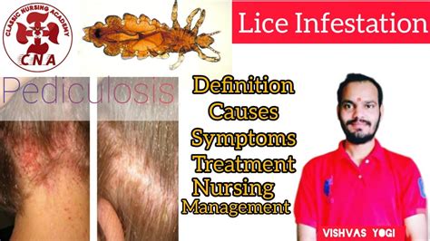 Pediculosis Lice Infestation Definition