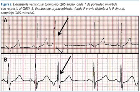 Arritmia Extra Sistólica Ventricular