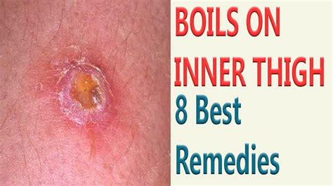 8 Best Remedies To Get Rid Of Boils On Inner Thigh Youtube