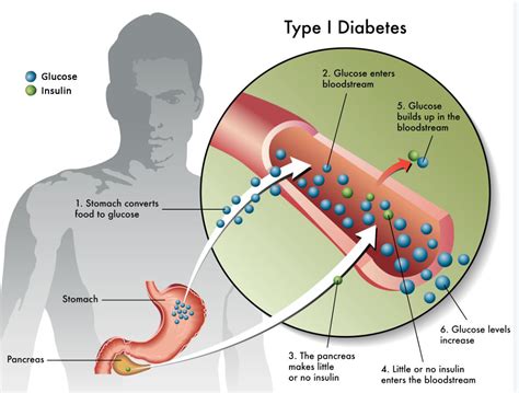 About Diabetes The Madison Clinic