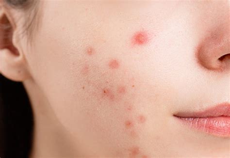 What Does Food Allergy Acne Look Like Heartomics