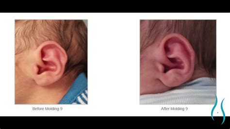 Infant Ear Molding For Newborn Ear Deformities In Connecticut Youtube