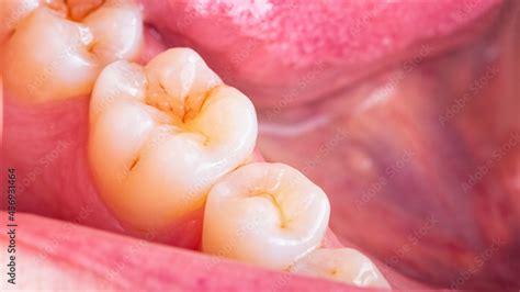 Symptoms Of Demineralization Of The Teeth Visible Signs Of Caries In