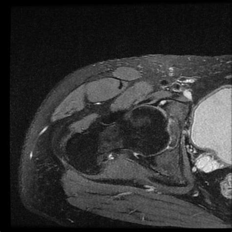 Paralabral Cyst With Anterior Acetabular Labral Tear Radiology Case